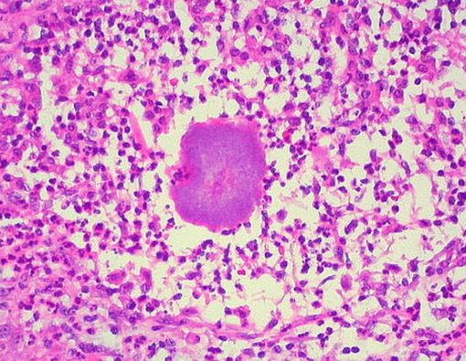 Mycetoma, Penyakit Kulit Kaki Kronis dari Jamur dan Bakteri