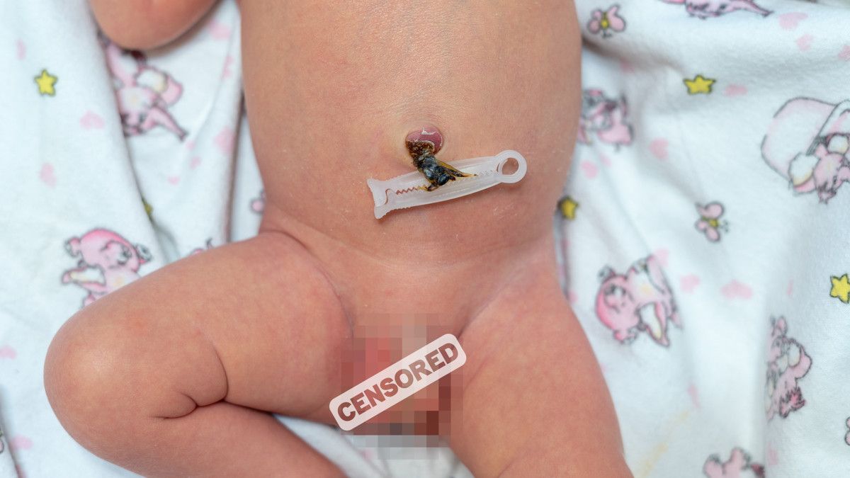 Solusi untuk Anak dengan Ambiguous Genitalia, Haruskah Selalu Operasi?
