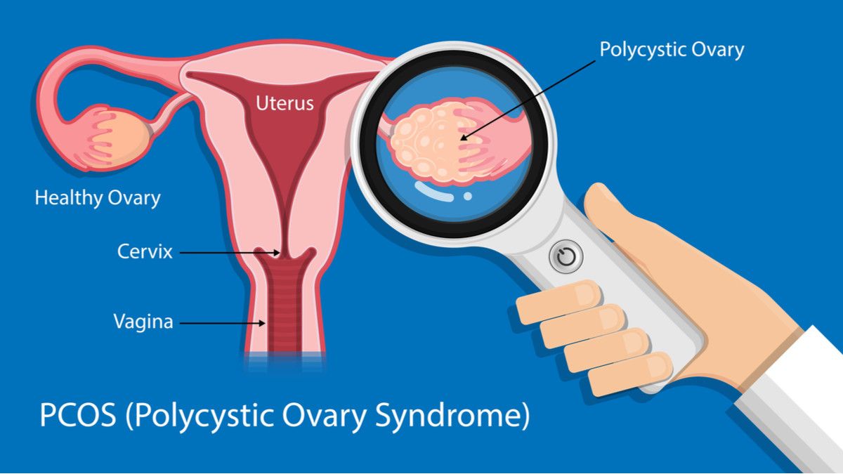 Kenali PCOS Lebih Jauh