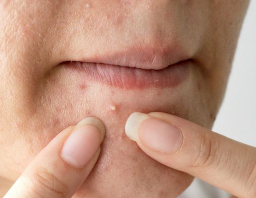 Jerawat di Dagu Muncul Terus, Apa Penyebabnya?