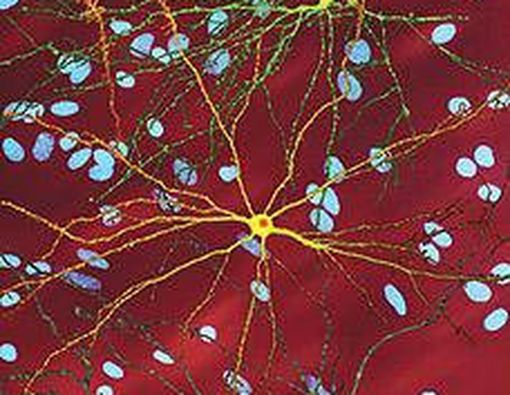 Pengobatan Baru Terhadap Penyakit Huntington