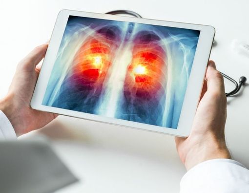 Seberapa Cepat Kanker Paru Menyebar ke Organ Lain?