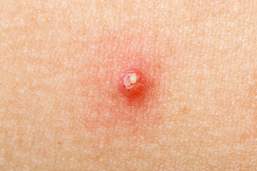 Apa Perbedaan Jerawat dan Bisul?