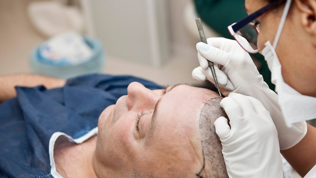 Mengenal Proses Transplantasi Rambut dan Efek Sampingnya - KlikDokter