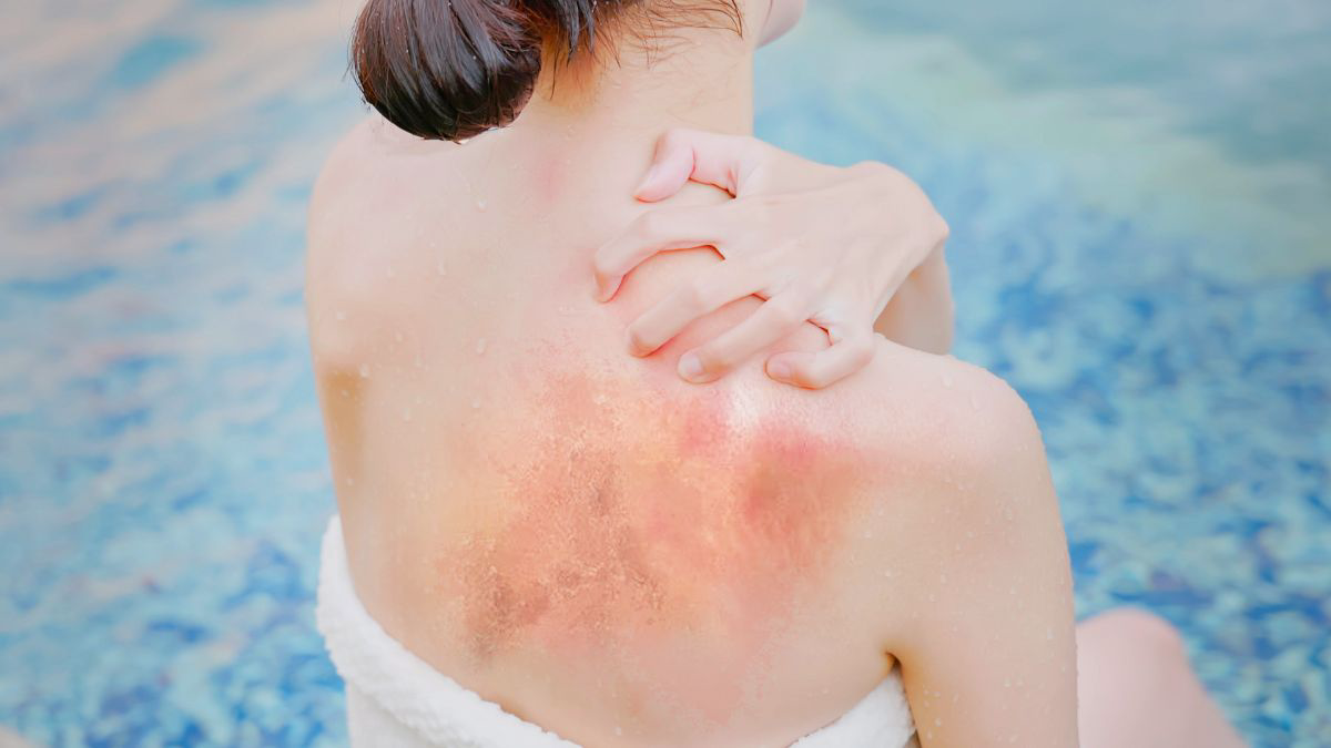 Gejala dari Panu Hitam