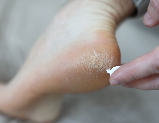 Tumit Pecah-Pecah, Atasi dengan Cara Ini