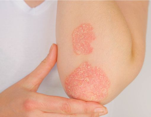 Psoriasis