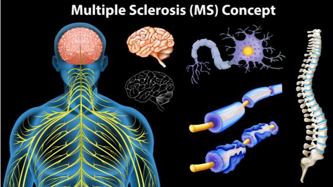 Mengenal Penyakit Autoimun Multiple Sclerosis Lebih Dekat