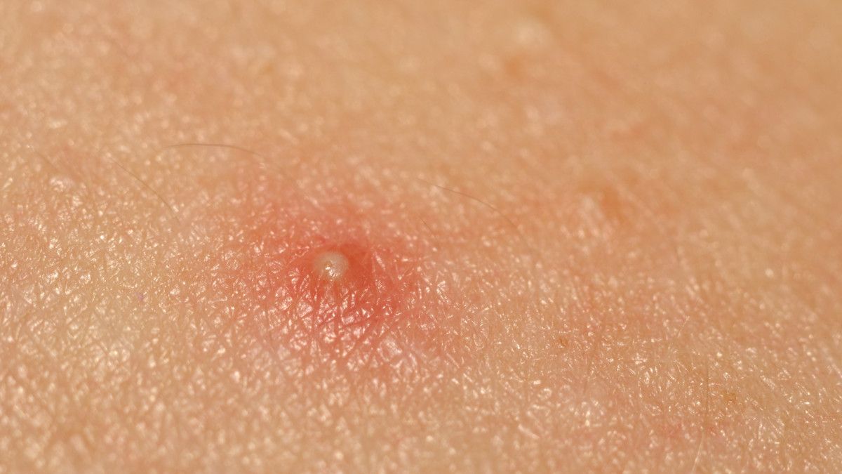 Ada Bisul di Anus (Abses Perianal), Apakah Seks Anal Penyebabnya?