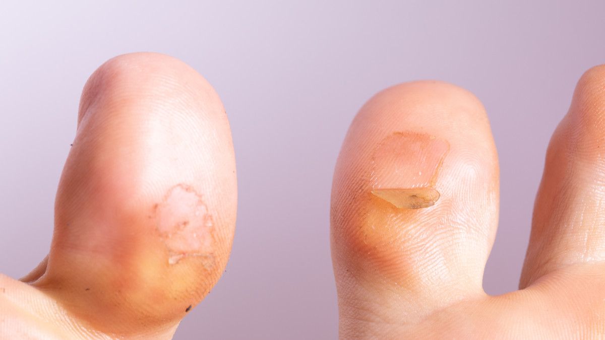 Kiat Atasi Kulit Melepuh bagi Jemaah Haji