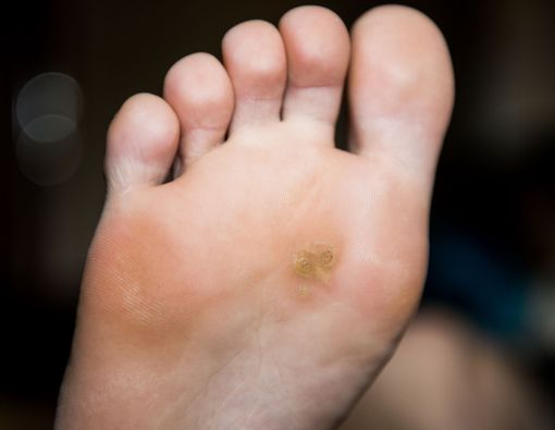 Menghilangkan Mata Ikan di Kaki, Perlukah Dioperasi?