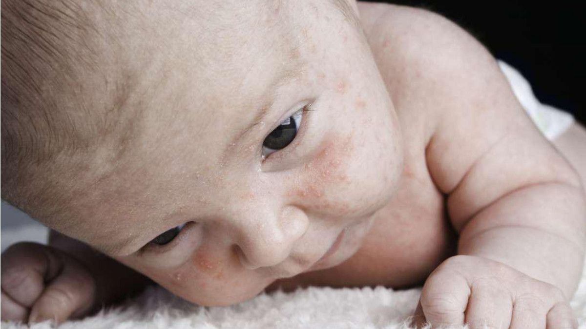 Akropustulosis, Penyakit Apakah Itu?