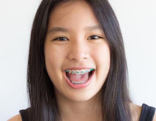 Usia Berapa Anak Boleh Memakai Kawat Gigi?