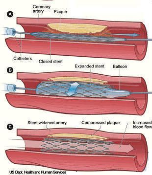 Stent Arteri Koroner