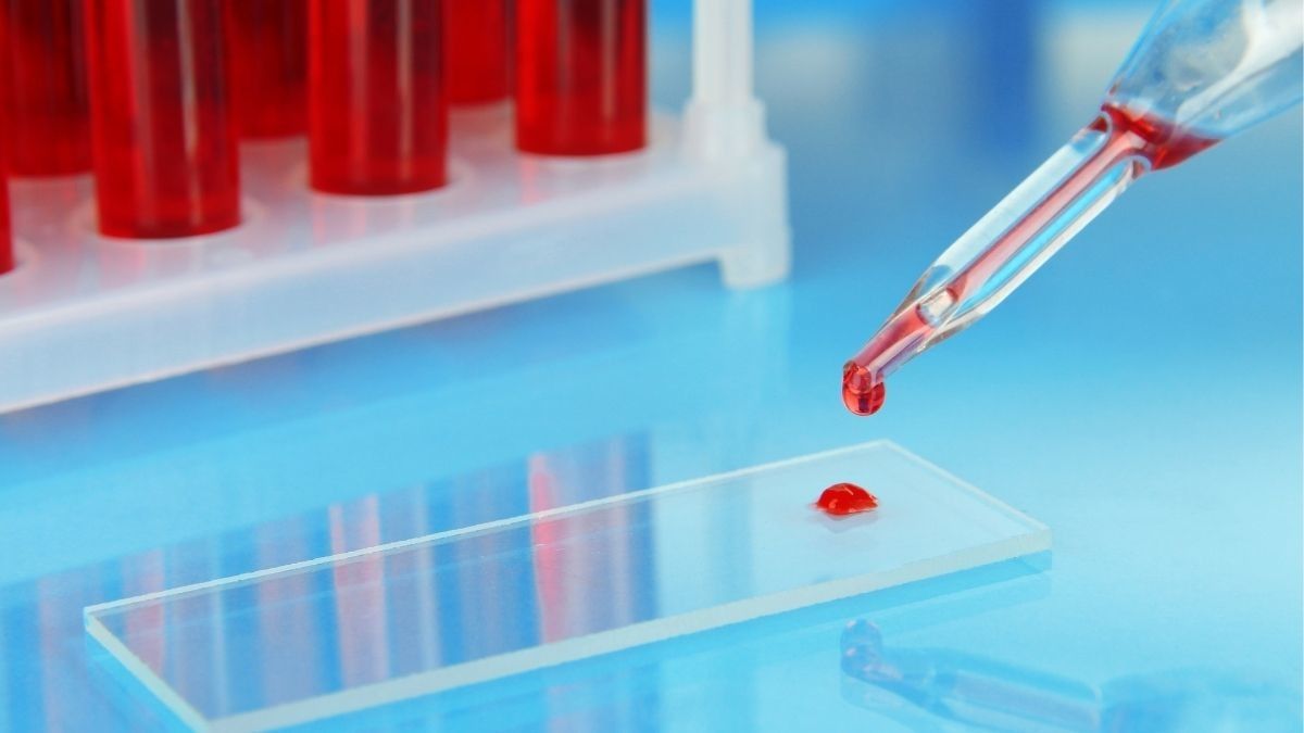 Mengenal Tes Anion Gap untuk Diabetes