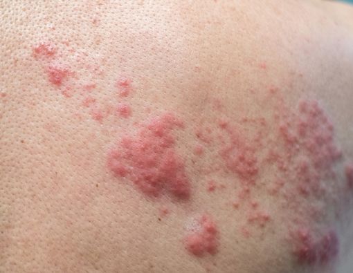 6 Cara Menghilangkan Bekas Cacar Api yang Menghitam