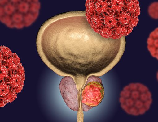 Kenali 5 Faktor Risiko Pemicu Kanker Prostat