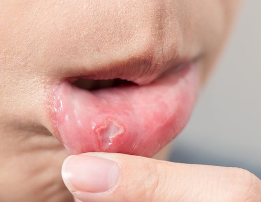 11 Rekomendasi Obat Sariawan Terbaik di Apotek