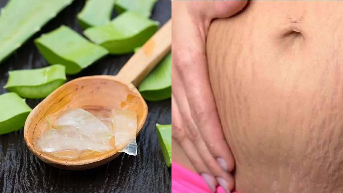 Cara Menghilangkan Stretch Mark dengan Lidah Buaya