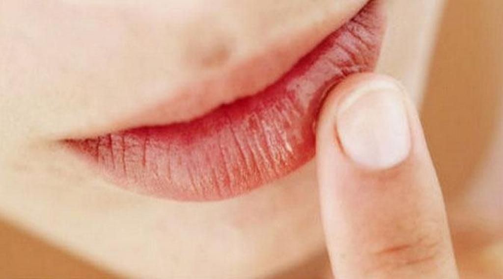 Intip 4 Penyebab Bibir Pecah-Pecah