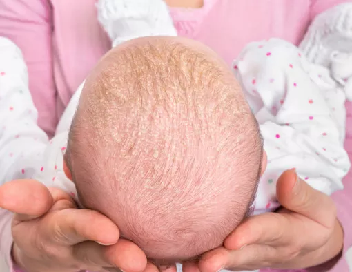 Ketombe Pada Bayi, Ini Cara Mengatasinya