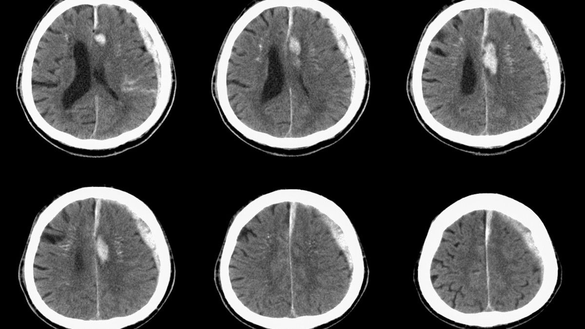 Mengenal Penyakit Hematoma Subdural, Perdarahan di Lapisan Otak