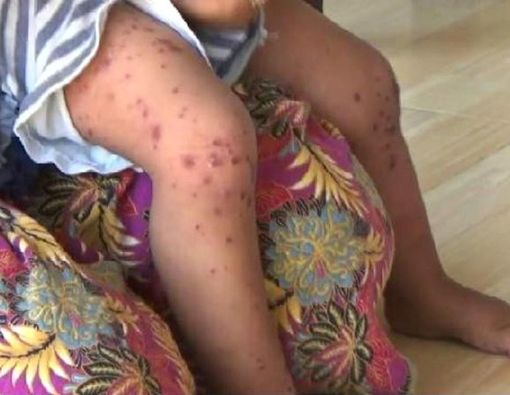 Kenali Gejala Flu Singapura untuk Lakukan Antisipasi