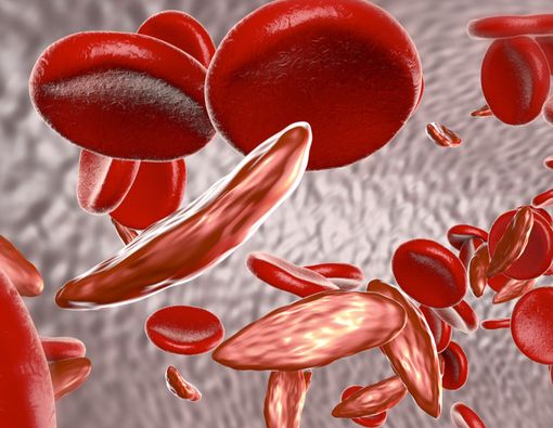Fakta Seputar Anemia Sel Sabit yang Wajib Diketahui