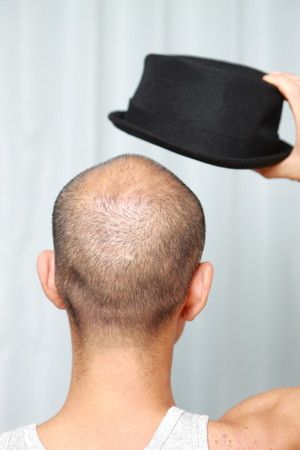 Benarkah Topi Sebabkan Kebotakan Permanen pada Pria?