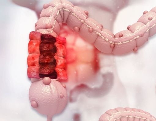 Hal yang Tidak Boleh Dilakukan Setelah Sembuh dari Kanker Kolon