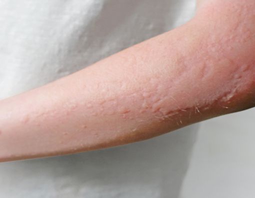 Dermatitis Kontak
