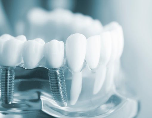 Tampil Manis dengan Gigi Gingsul Buatan, Apakah Aman?