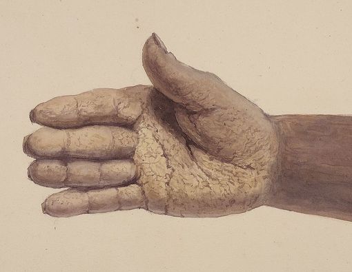 Mengenal Penyakit Kulit Langka Pemfigus Vegetans