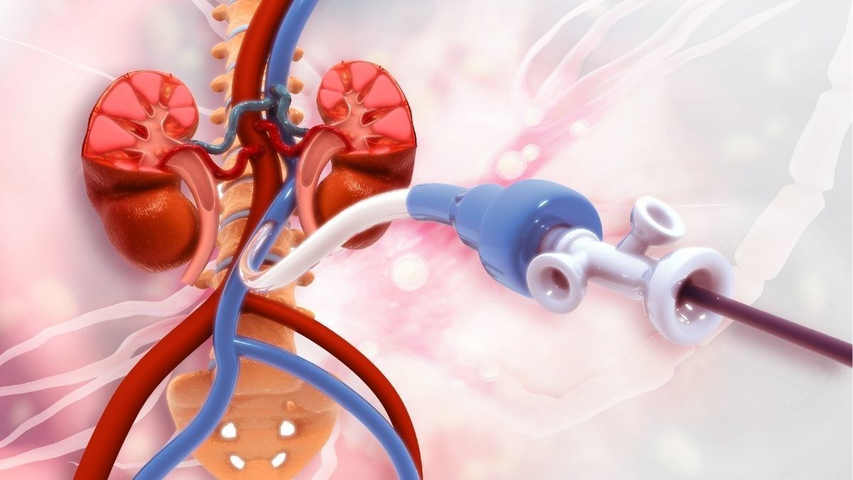 Tips Tidur Tetap Nyaman untuk Orang dengan Stent Ginjal