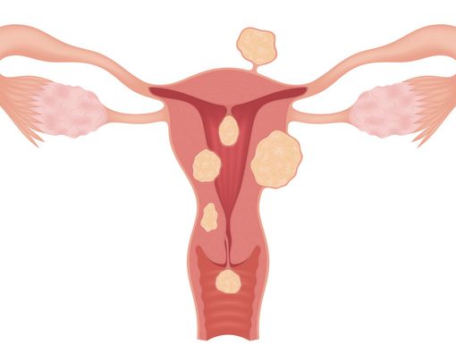Inilah Ciri Sakit Perut Akibat Miom