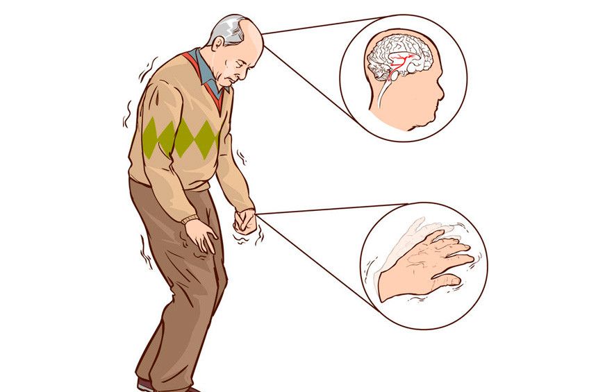 Benarkah Penyakit Parkinson Bermula dari Usus?