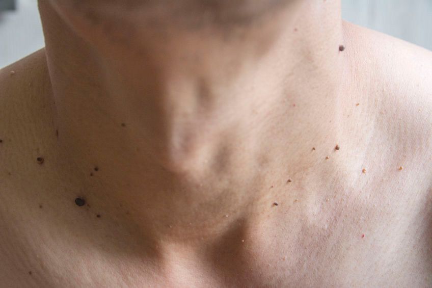 Memiliki Banyak Tahi Lalat, Haruskah Khawatir?