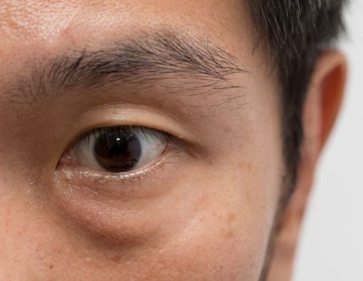 Manfaat Vitamin K untuk Mengatasi Mata Panda