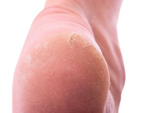 Cara Atasi Tumit Kering