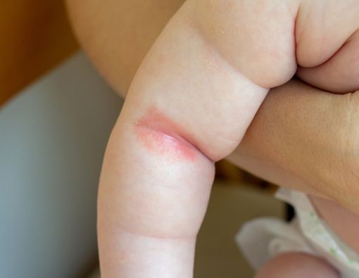 Psoriasis Bisa Terjadi pada Bayi, Kenali Gejalanya!