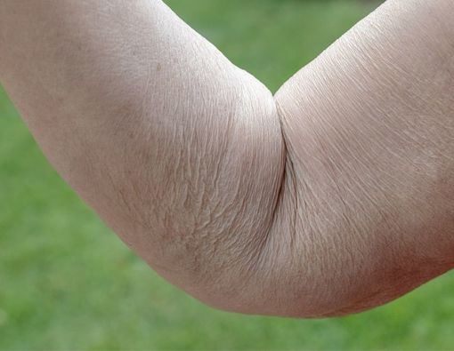 Mengenal Elastoderma, Penyakit Genetik Bikin Kulit Kendur