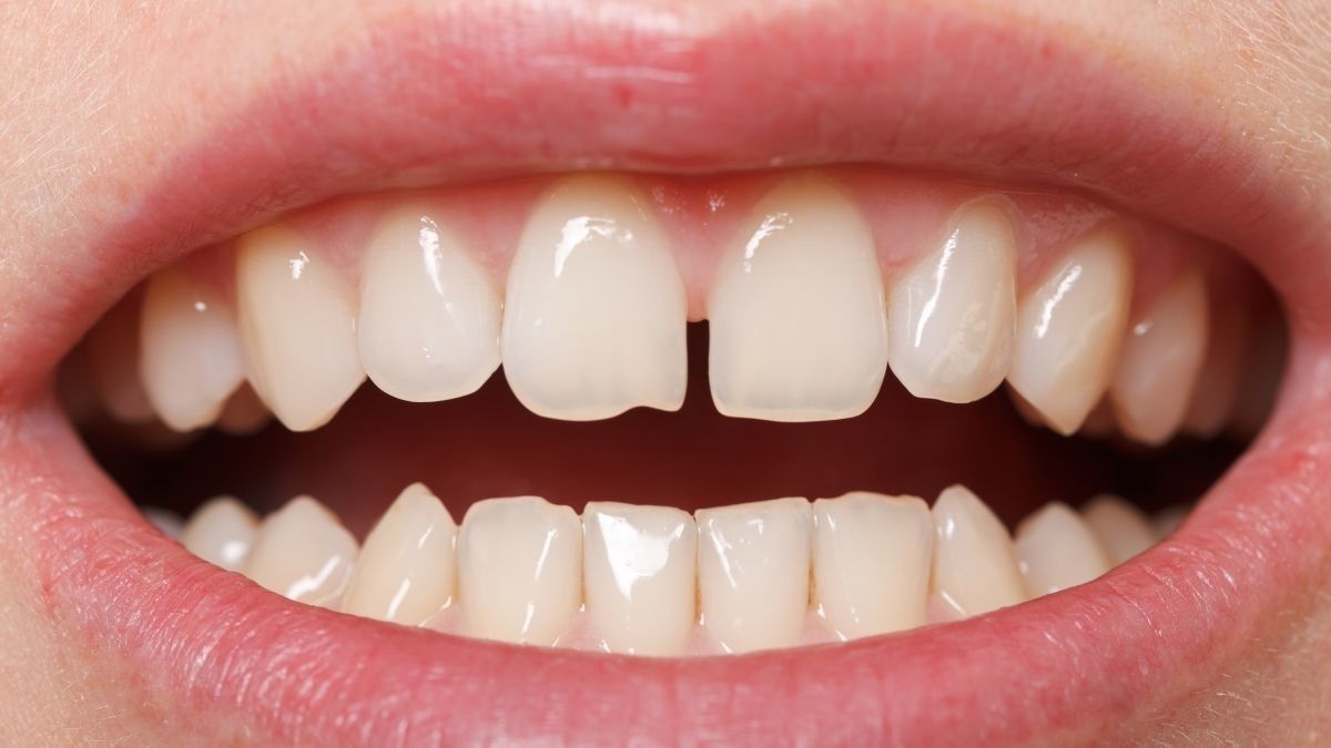 Perlu Tahu, Ini Cara Mengatasi Gigi Bercelah