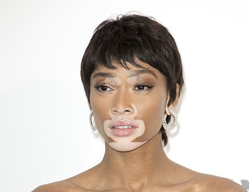 Kenali Vitiligo, Kelainan Warna Kulit yang Bikin Kulit Jadi Belang