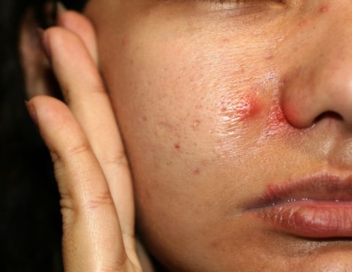 Bisul Selalu Muncul Saat Haid, Apa yang Salah?