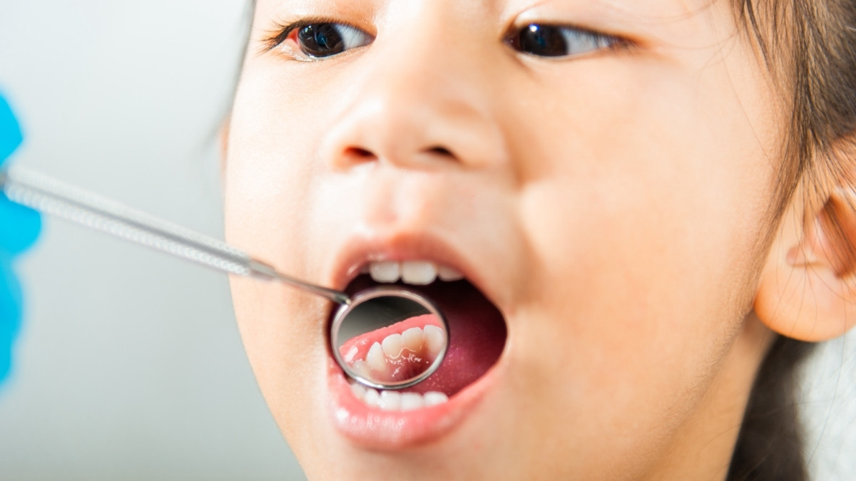 7 Penyebab Gigi Anak Keropos, Orang Tua Harus Tahu!