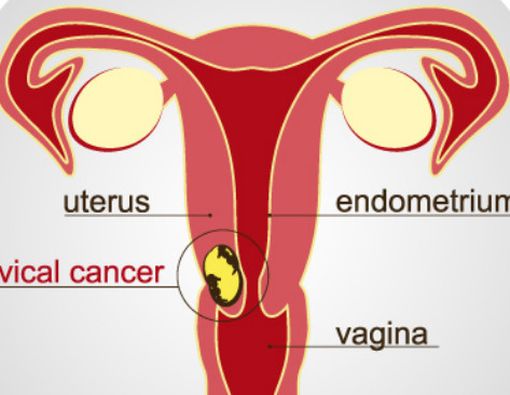 Hasil Pap Smear Tidak Normal, Sudah Pasti Kena Kanker Serviks?