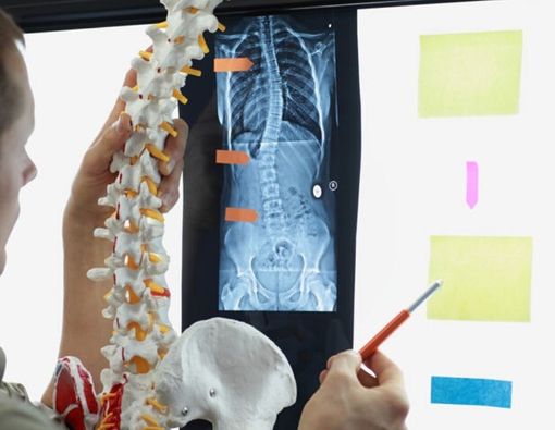 Apakah Kebiasaan Tertentu Bisa Jadi Penyebab Skoliosis?
