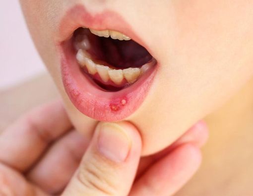 Cara Alami Mengobati Sariawan