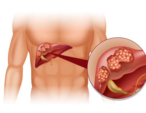 Gejala Kanker Hati yang Merenggut Nyawa Komika Gebi Ramadhan