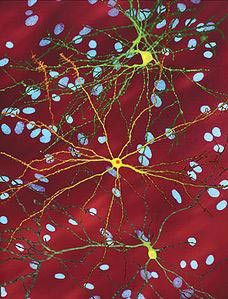 Pengobatan Baru Terhadap Penyakit Huntington